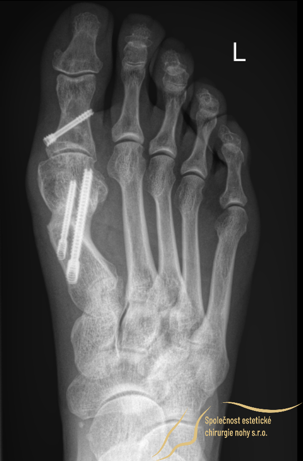 X-ray of healed bones of a bunion